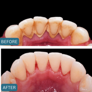 Dental Scaling Price in Pakistan - General Dentsitry