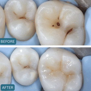 Teeth Filling in Islamabad - General Dentistry results