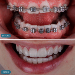 Before After of teeth braces