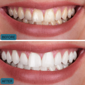 Before After results of Cosmetic Dentistry in islamabad