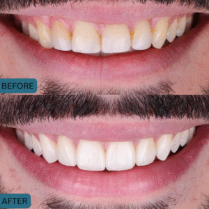Best Results of Cosmetic Dentistry- whitening teeth treatment