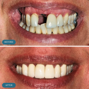 Best dental implants results in Islamabad