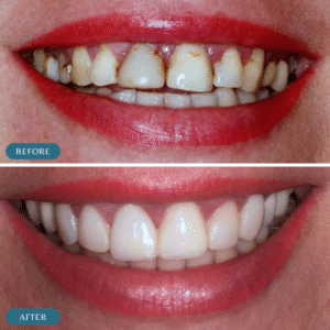 Best results of Gum Grafting in islamabad
