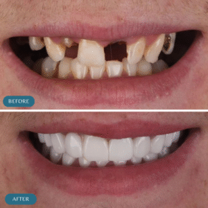 Dental Implant results