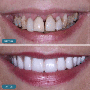 Gum Grafting Before After results