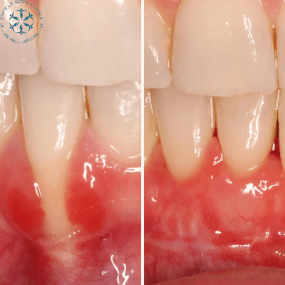 Gum Grafting in Islamabad