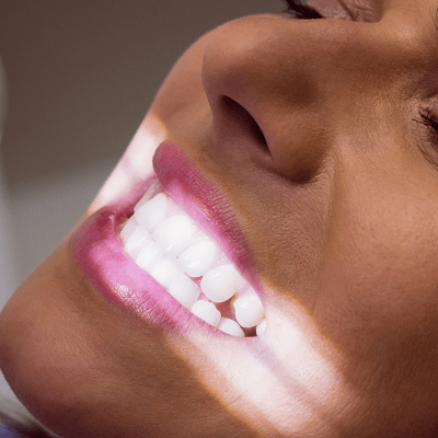 Laser Teeth Whitening in Islamabad