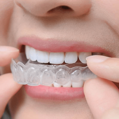 Teeth Aligners in Islamabad