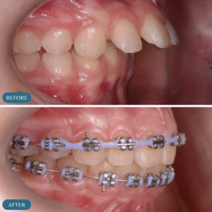 Teeth Braces Price in Pakistan