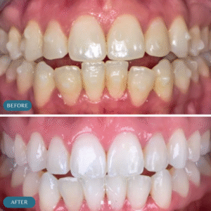 Teeth Whitening Results - Yellow teeth Treatment