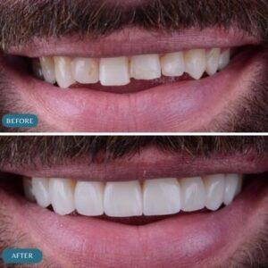 before and after results of teeth aligners