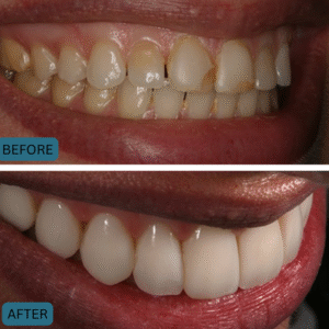 cosmetic dentistry in islamabad - fractured tooth treatment