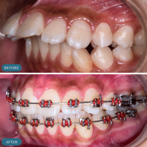 dental-braces-in-islamabad-pakistan