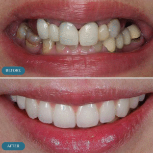 dental implants before and after results