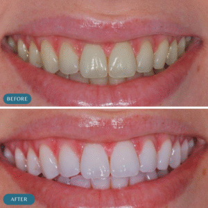 laser teeth-whitening-in-islamabad