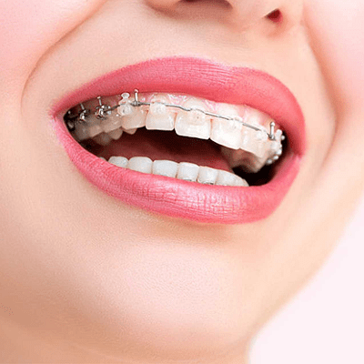 Teeth Braces Price in Pakistan