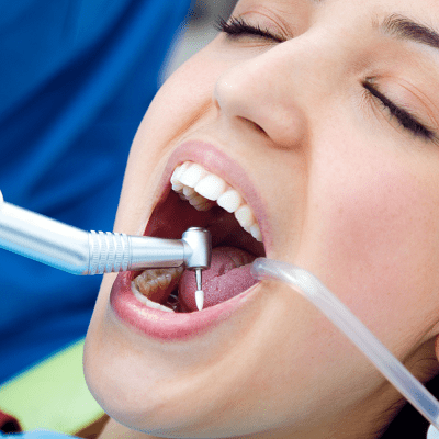Teeth Scaling and Polishing