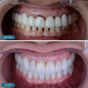 zirconia crown before-and after