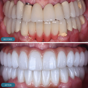 zirconia crown before and after photos