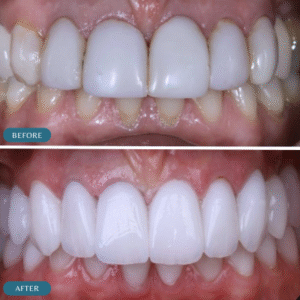 zirconia crown in islamabad
