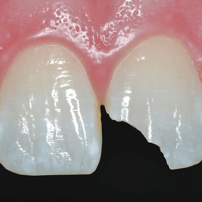 How Much Does It Cost to Fix a Fractured Tooth in Islamabad ?
