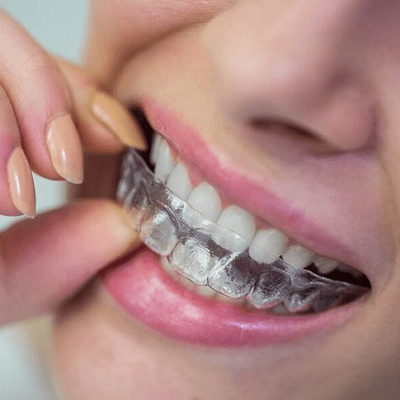 Are aligners a quicker treatment option compared to braces