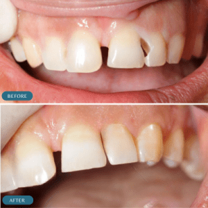 before-and-after-photos-dental-fillings-for-children-success