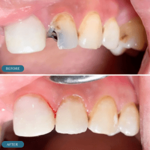 dental-fillings-for-children-visible-improvement-before-and-after