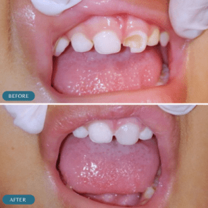 kids-dental-fillings-transformation-in-islamabad-before-and-after