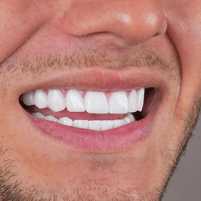 Are The Results Of A Smile Makeover Truly Worth It