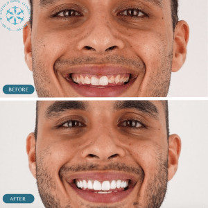 dental-veneers-in-pakistan