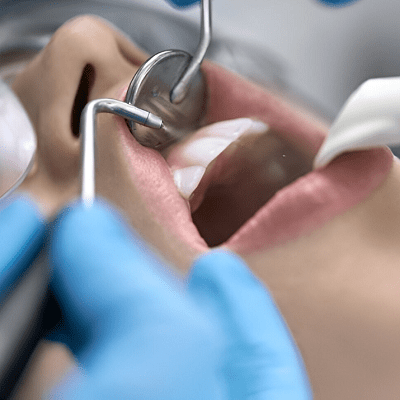 Do You Always Need a Root Canal Before Placing a Crown