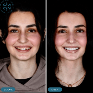 permanent-dental-veneers-before-and-after (1)