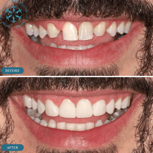 porcelain-veneers-treatment-in-islamabad-before-and-after-photo (1)