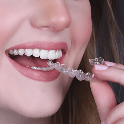 Transparent Braces Cost in Pakistan