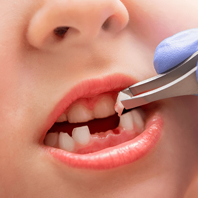 What Should Children Avoid After Having a Tooth Extracted