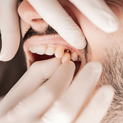 Which Is Better, Bridge Or Implant