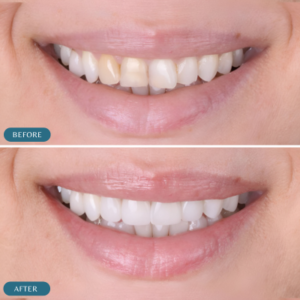hollywood-smile-in-islamabad-before-and-after-results