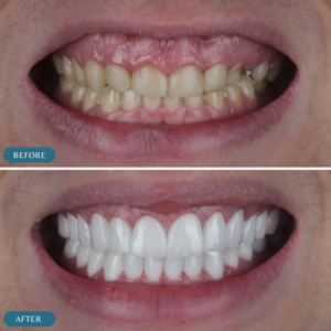 hollywood-smile-makeover-in-islamabad-before-and-after