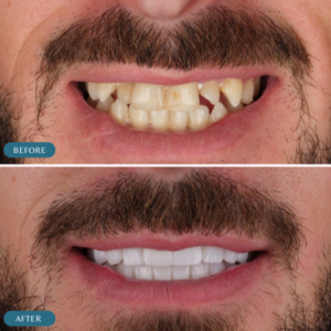 hollywood-smile-teeth_-transformation-before-and-after-results