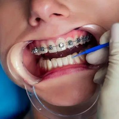 Can Braces Cause Headaches or Jaw Pain