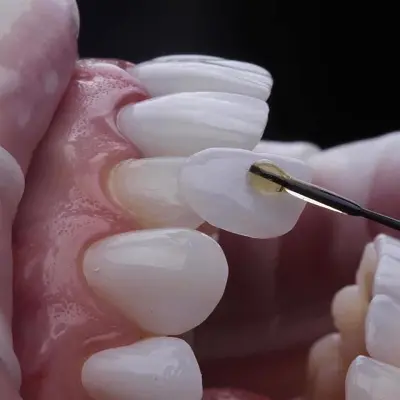 Veneers to Improve Teeth Color & Shape