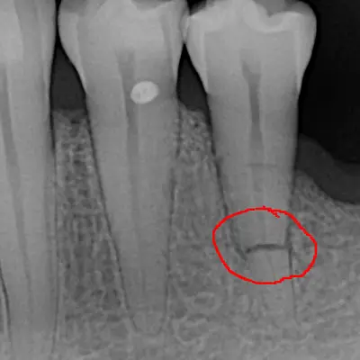 Can a Fractured Tooth Root Heal On Its Own