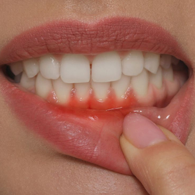How Does Gum Recession Cause Tooth Pain
