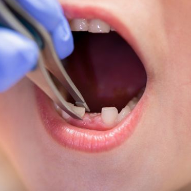 Is Tooth Extraction Safe for a 7-Year-Old