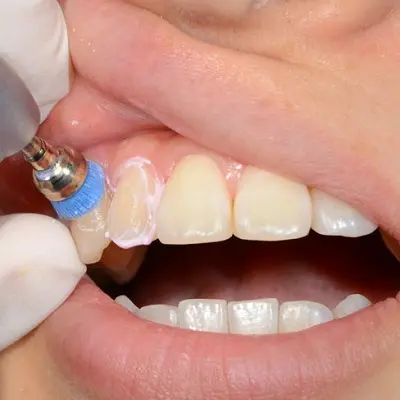 Top Benefits of Regular Dental Scaling and Polishing