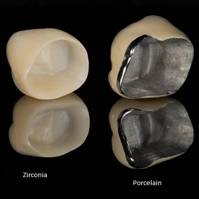 What Is the Lifespan of Zirconia and Porcelain Crowns